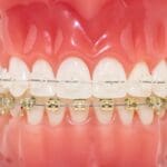 Need braces for you kids? Prime Family Dental in Laveen can help.