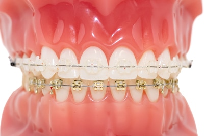 braces